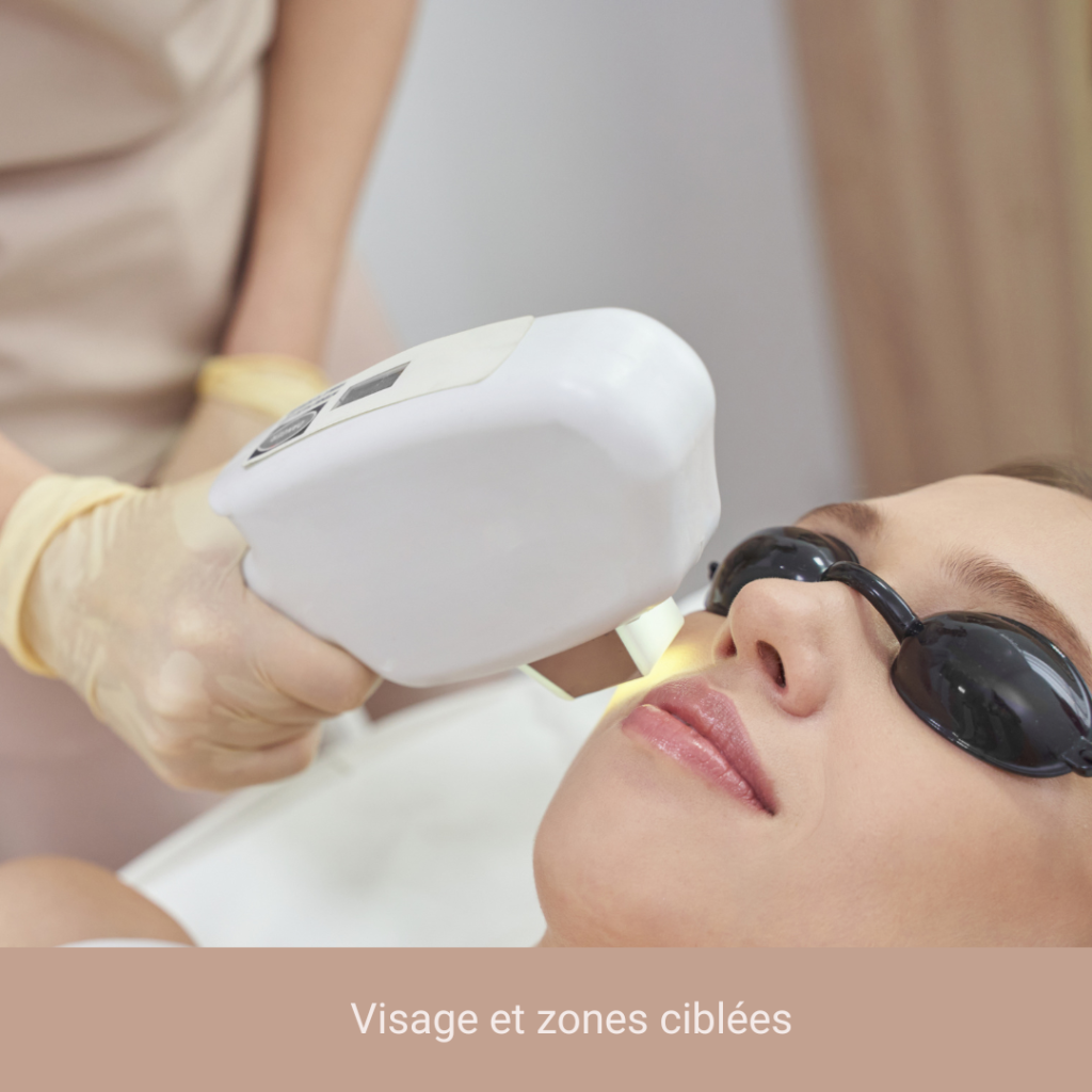 epilation laser visage