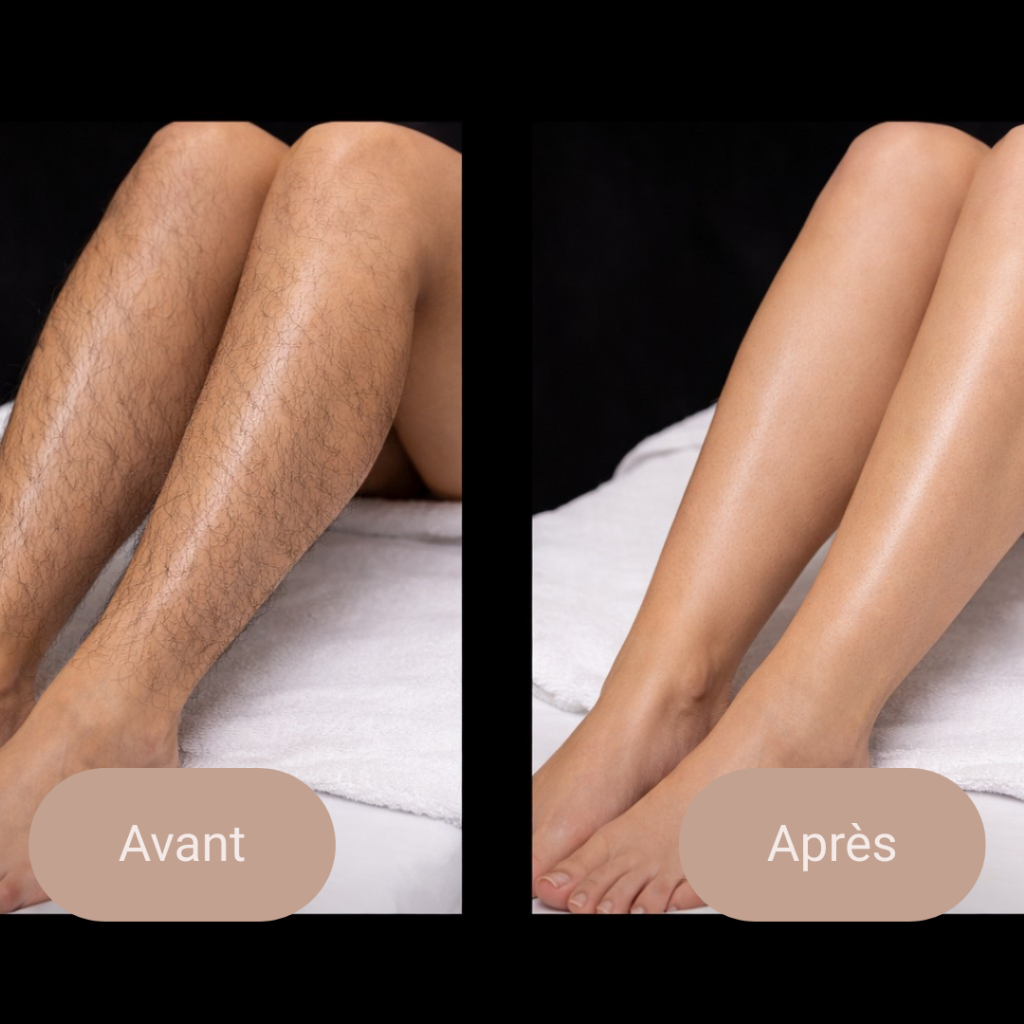 epilation laser montreal