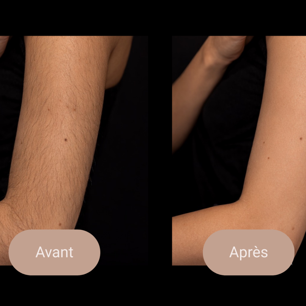 épilation laser montreal