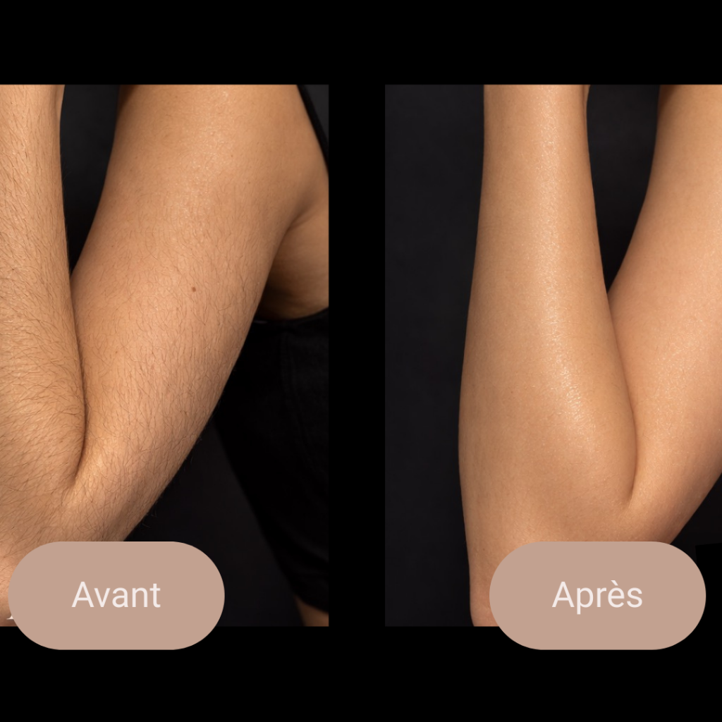 épilation laser montréal