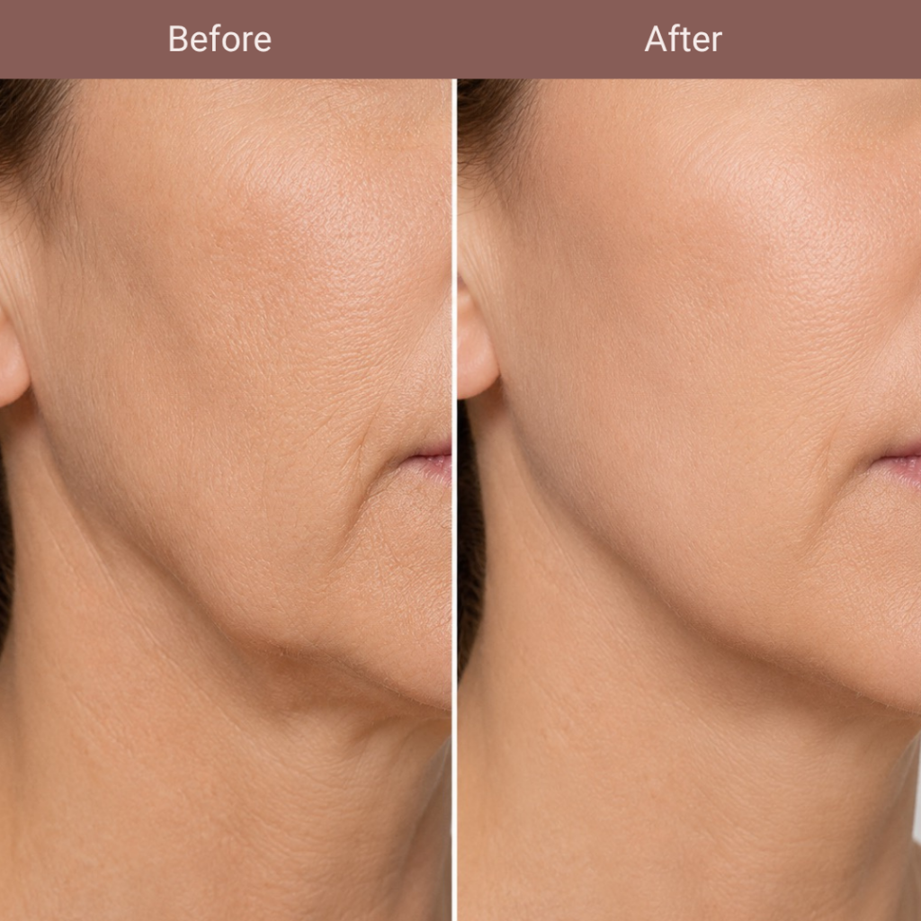 Montreal injections before and after